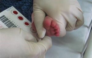 96 نوزاد مبتلا به کم‌کاری تیروئید در زاهدان شناسایی شد