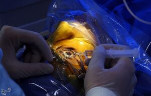 جراحی رایگان چشم 150 بیمار کم‌بضاعت به همت سپاه در سنندج