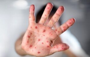 آغاز طرح تکمیلی واکسیناسیون سرخک در استان کرمان